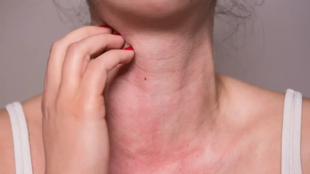 mulher com alergia no pescoço
