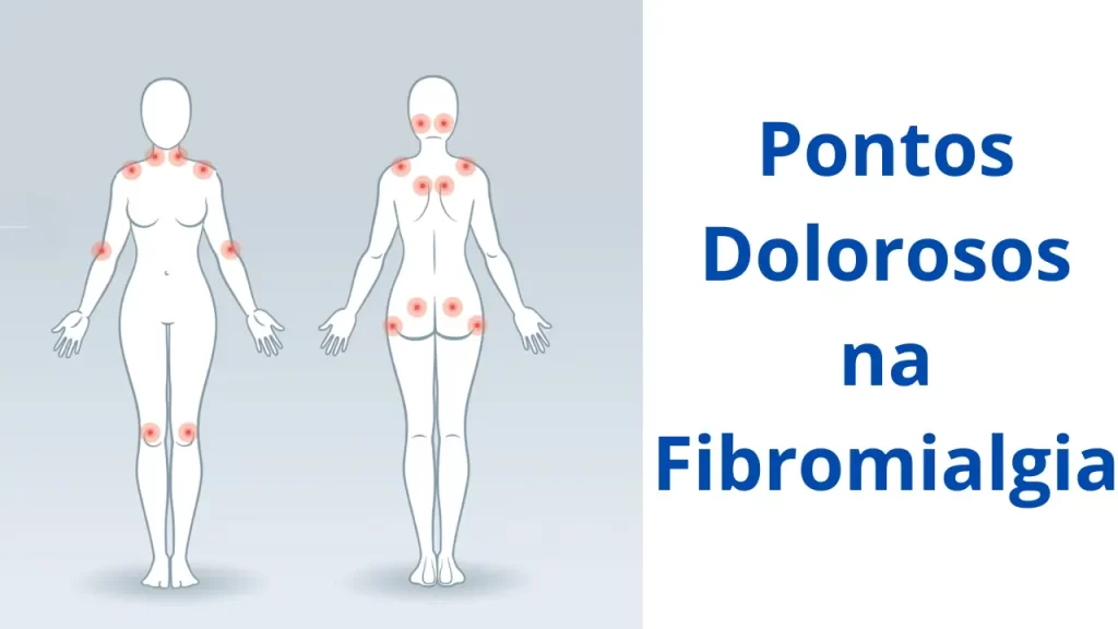 Infográfico mostrando pontos de dor da fibromialgia em mulher na menopausa